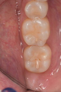 Restauri usurati e infiltrati che devono essere rifatti