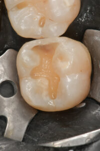 La parete interprossimale ricostruita con smalto BF2