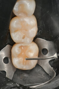 Si posiziona uno strato di Flow UD4 sul fondo della cavità