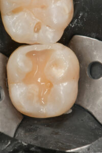 Lo strato di Flow UD4 polimerizzato