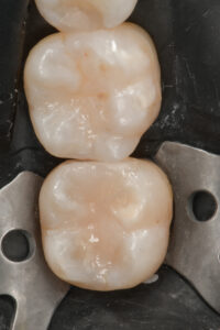 Si completa la forma con
smalto BF2